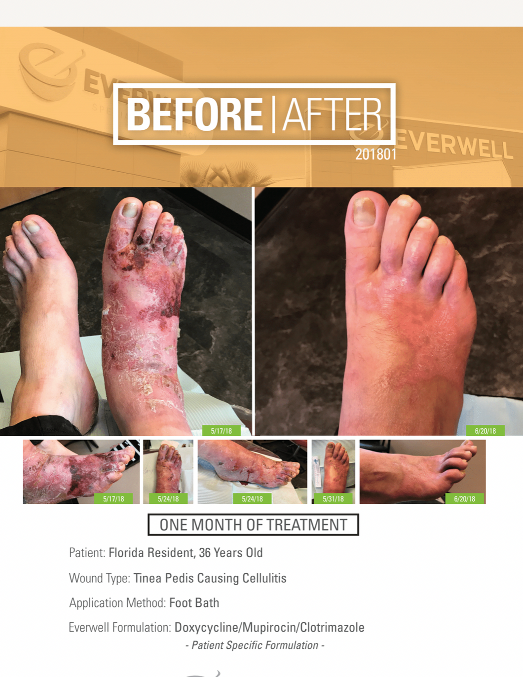 Everwell - Tinea Pedis - Before and After